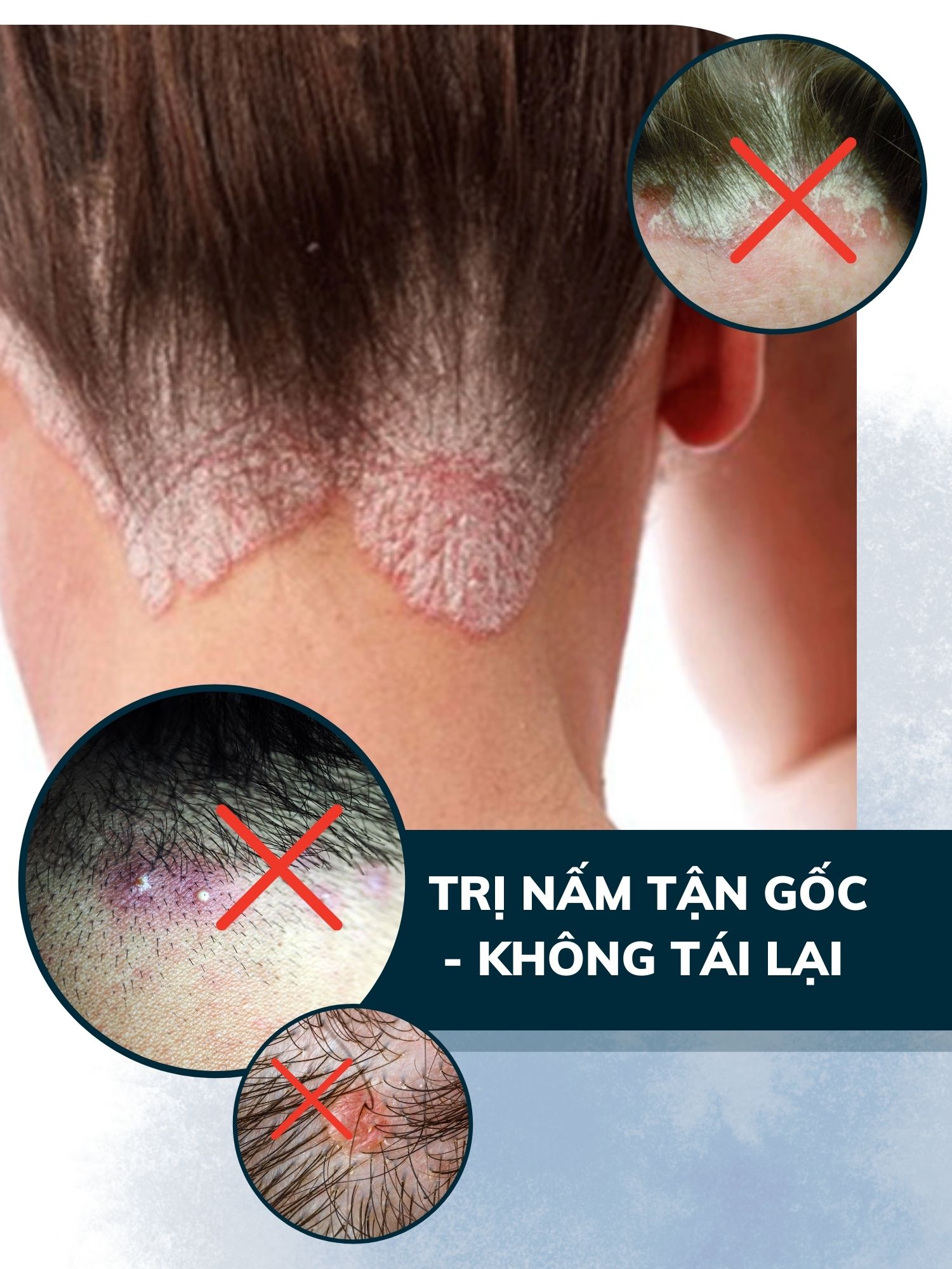 Combo 2 dầu gội sạch gàu hết ngứa Dego Pharma chiết xuất hoàn toàn từ thiên nhiên cải thiện tình trạng vảy nấm (80ml)