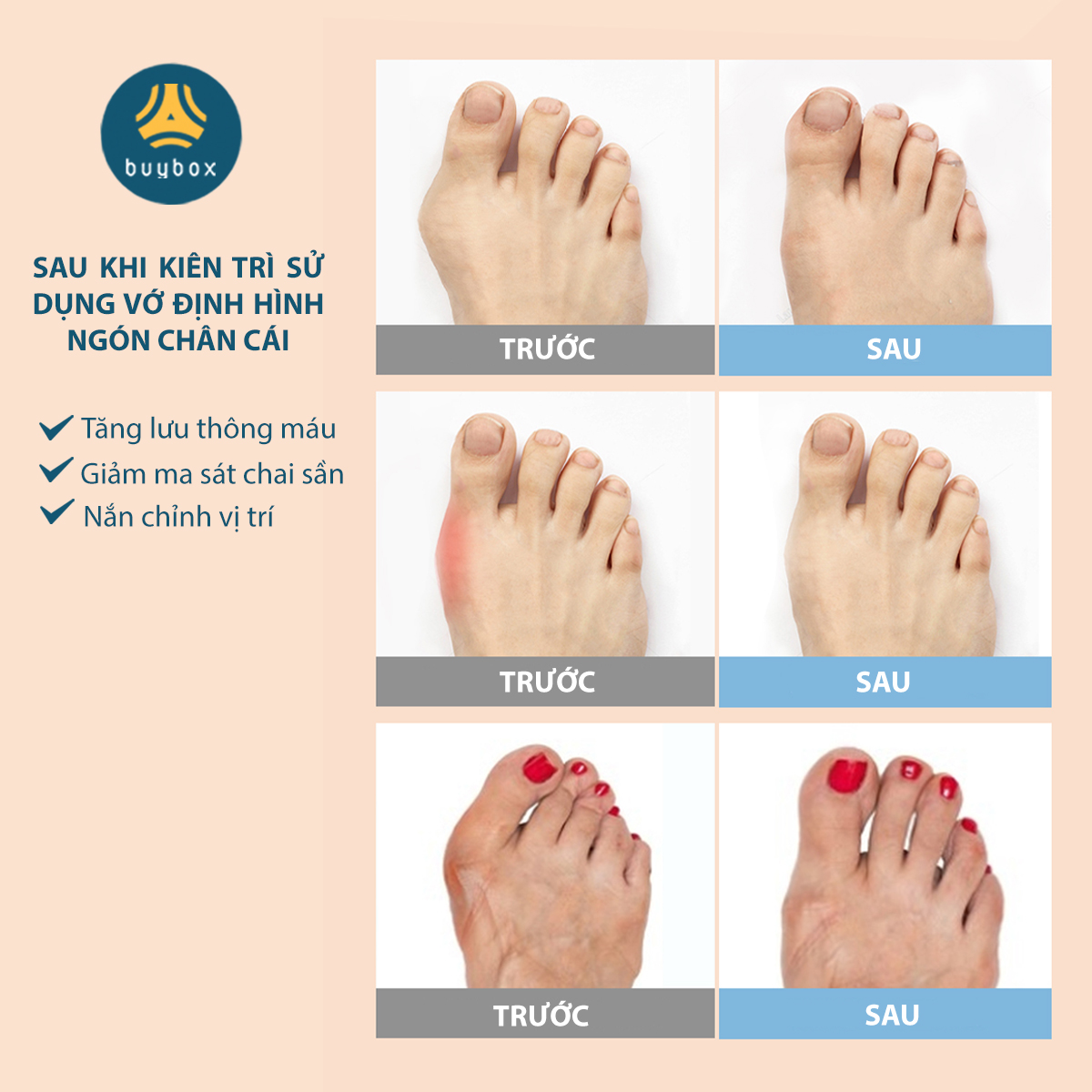 Vớ cotton pha vật liệu đàn hồi SEBS bảo vệ và chỉnh hình tách ngón chân cái bị vẹo Hallux Valgus - Buybox - BBPK278