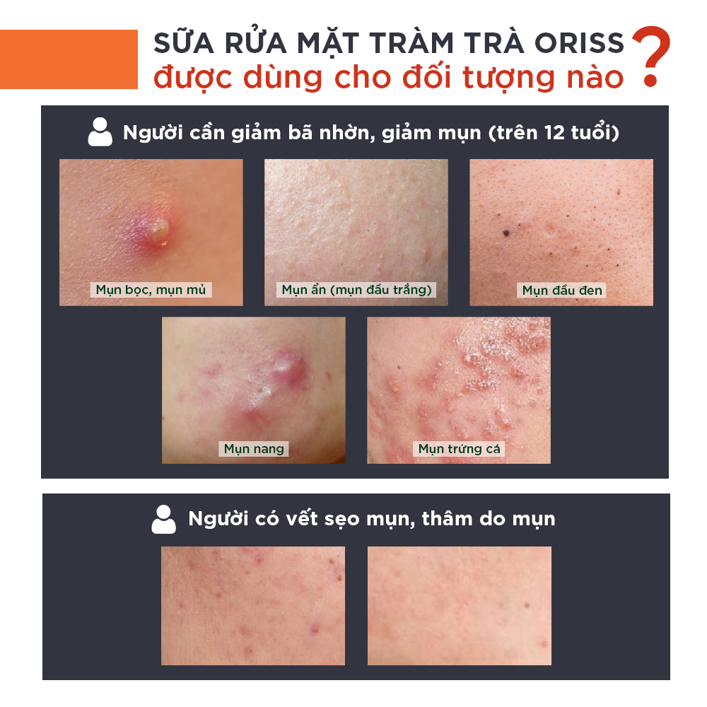 Sữa Rửa Mặt Tạo Bọt Ngừa Mụn Oriss 100g - Chuyên Dành Cho Da Mụn