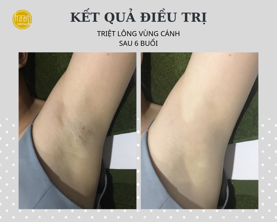 Triệt Lông Nách Công Nghệ Laser Diode Tại Haan Spa