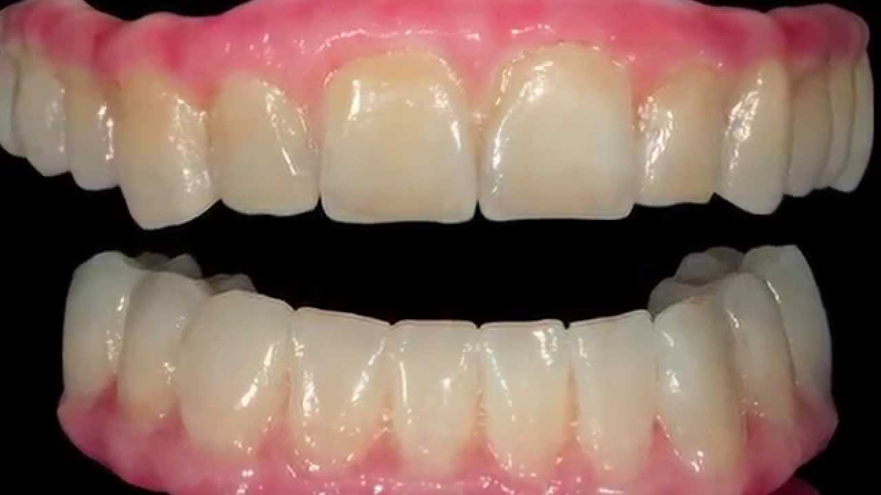 Bọc 1 răng sứ Cercon HT tại Nha Khoa Gia Hân