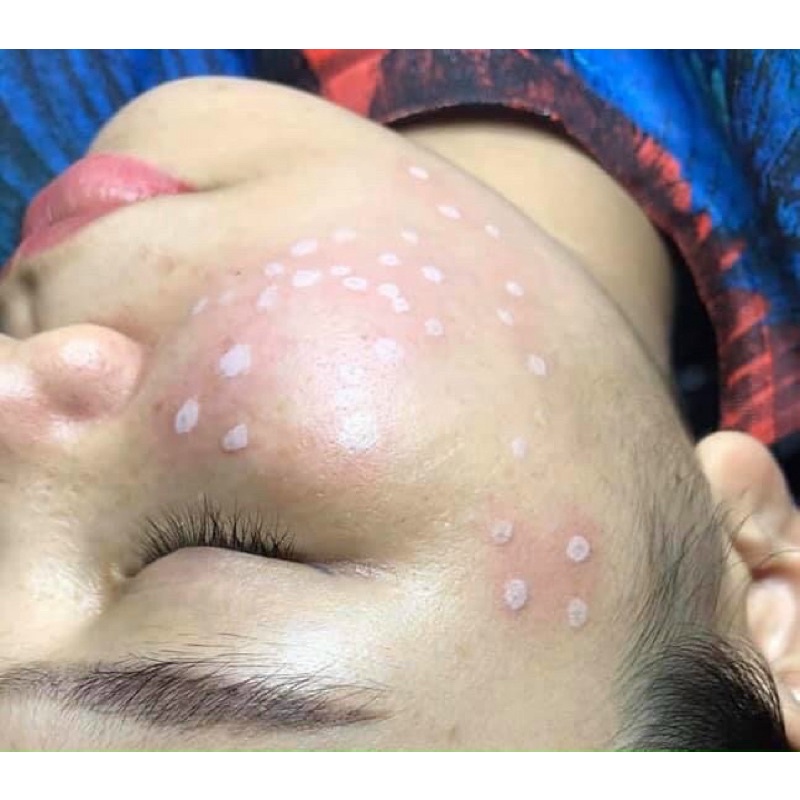 Chấm tàn nhang nám rỗ yody white phương anh - lọ 2ml