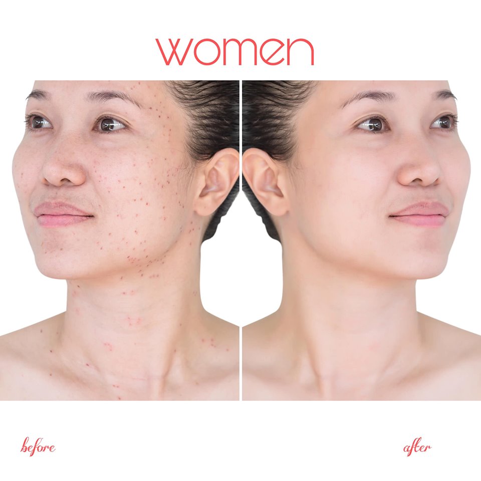 Tinh Chất Giảm Mụn, Mờ Thâm 24h Nam Nữ -Anti Acnes Pro Myloky 10