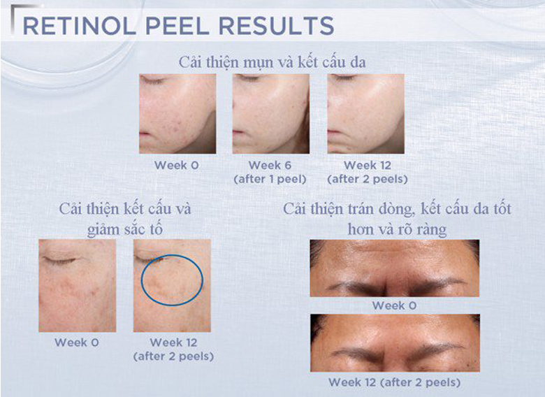Peel da giảm nếp nhăn sạm da NeoStrata ProSystem Retinol Peel 1.5ml