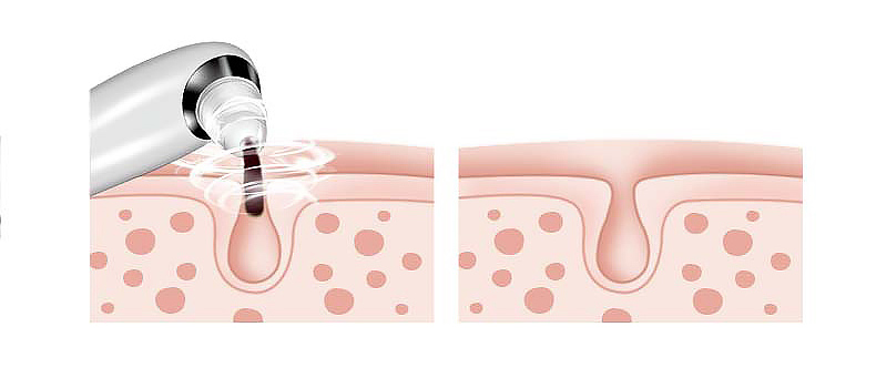 Máy Hút Mụn Đầu Đen BlingBelle Máy Hút Mụn Đầu Đen BlingBelle