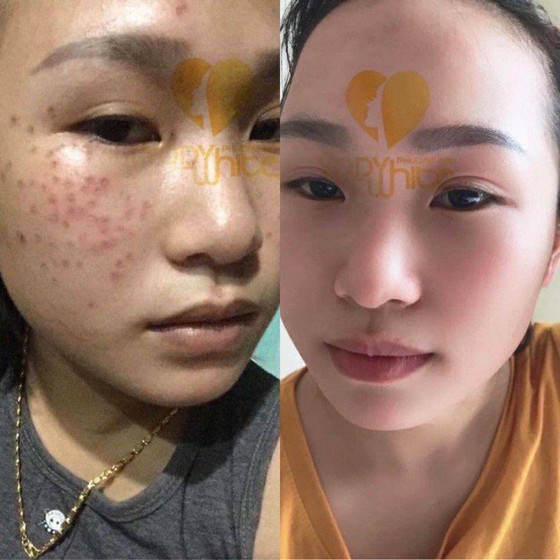 Chấm tàn nhang nám rỗ yody white phương anh - lọ 2ml