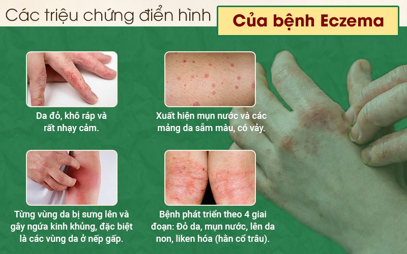 các triệu chứng của bệnh Eczema