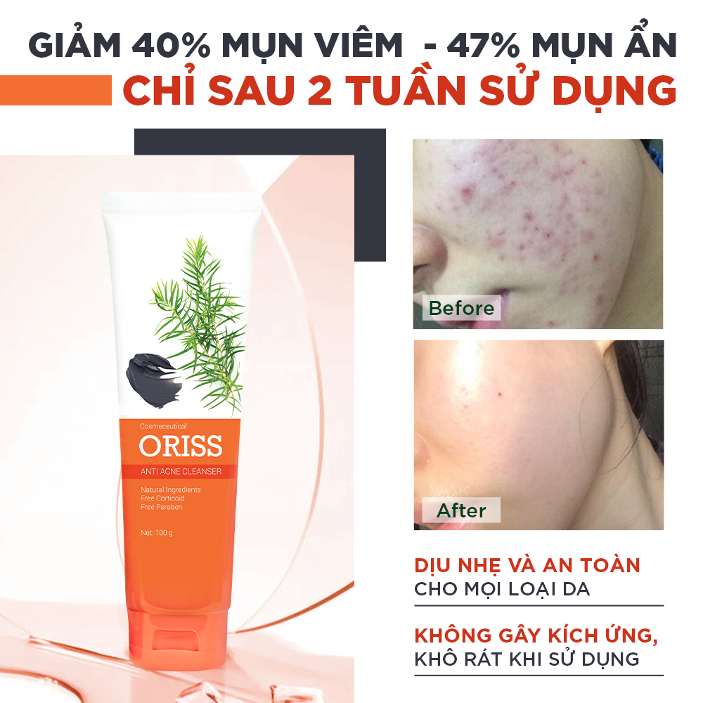 Sữa Rửa Mặt Tạo Bọt Ngừa Mụn Oriss 100g - Chuyên Dành Cho Da Mụn