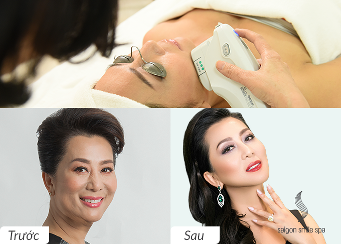 Làm Trắng Da Chống Lão Hóa Yuki - Saigon Smile Spa