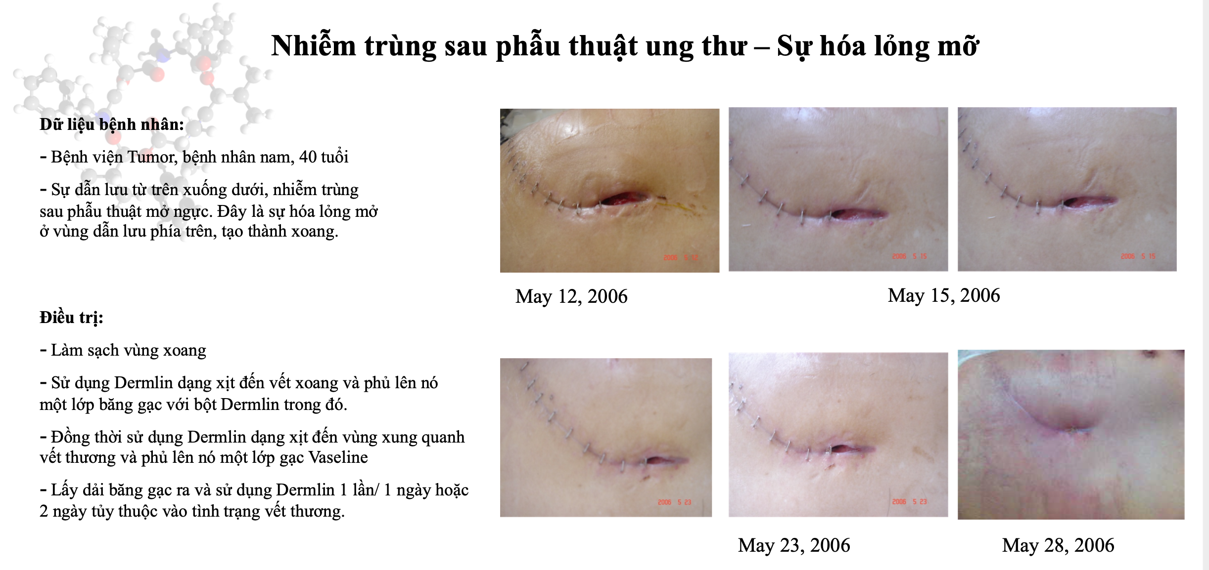 Vết thương phẫu thuật 